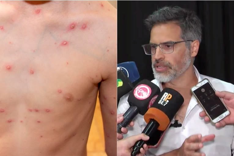 Preocupante: Se Notificaron mas de 700 casos de Varicela en Entre Rios