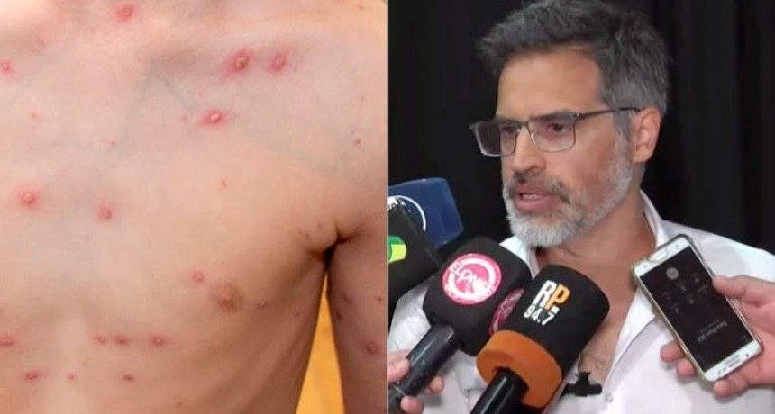 Preocupante: Se Notificaron mas de 700 casos de Varicela en Entre Rios